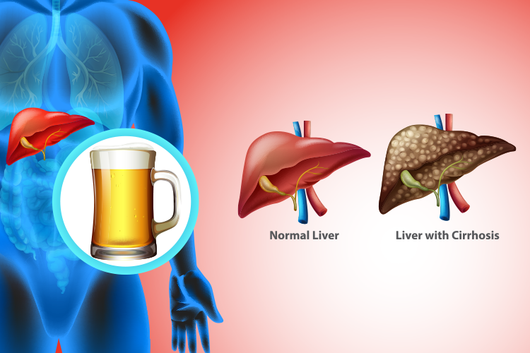 Alcoholic liver illustration